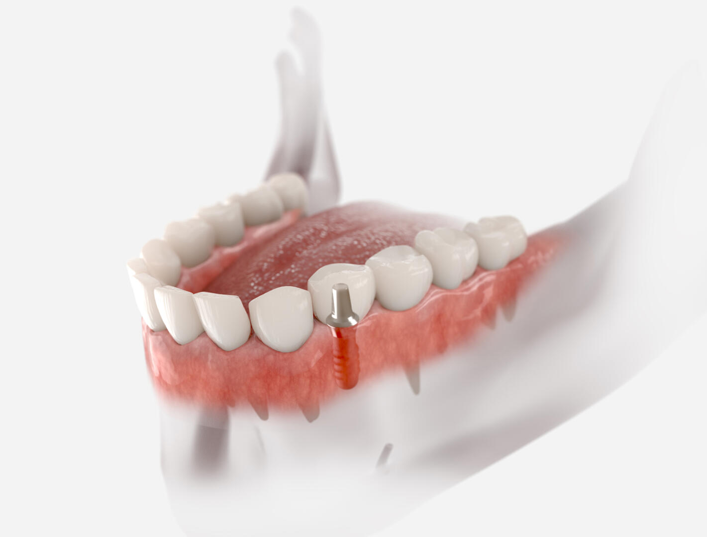 Premolar tooth implant